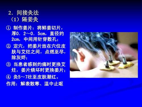 中医灸法ppt
