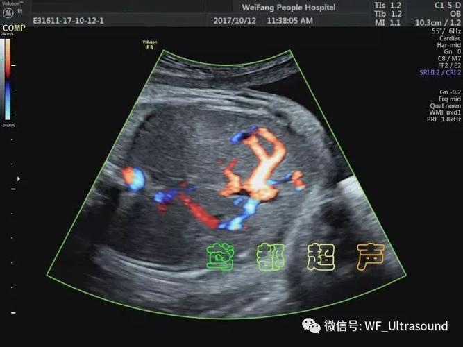 胎儿静脉导管缺如的超声表现