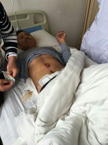 这是位直肠造瘘病人,老人家一脸的刚强,听着白衣天使给他亲属细心的