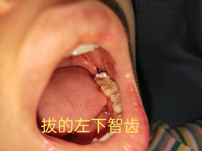 拍片的时候看见自己的智齿长歪了是阻生齿,不拔后患无穷,诊所医生说