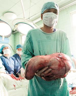 9.49公斤 肌瘤比孩子 重四倍还多(图)