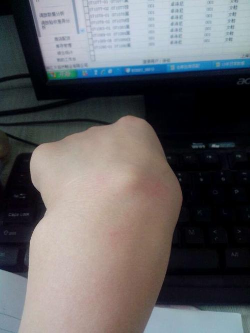 我想知道我手腕处鼓起一个包很硬就像骨头一样 按的话会疼这是什么