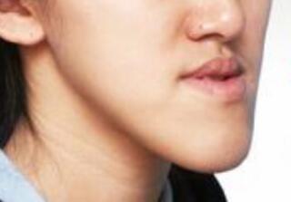 地包天牙齿怎么引起?