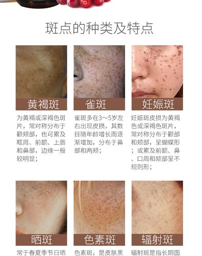 2018斑点克星 草本分解黑色素老中医祛斑霜正品祛斑美白 淡化色斑_7折
