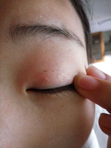 眼睛上长了些疹子,用金霉素眼膏也没有效果,平常也就贴了双眼皮贴,越