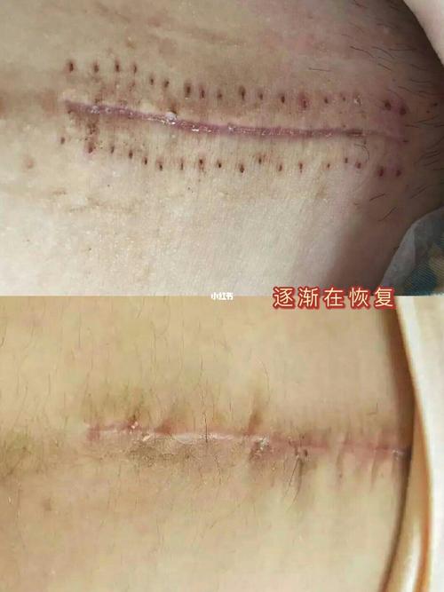 我这么丑的剖腹产刀疤你见过吗?