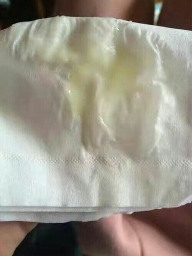 有些良性病变也有可能出现这种白带,如宫颈息肉,黏膜下肌瘤,重度慢性