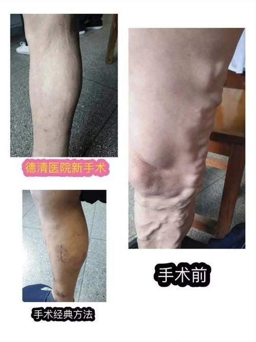 下肢静脉曲张,手术疤痕难看,裙子穿不了怎么办?