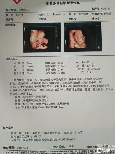 无创低风险24周四维鼻骨缺失