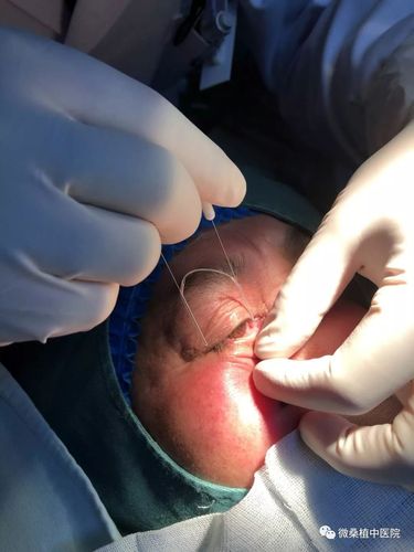 一般是先把泪道探通,然后植入一个管子支撑,等泪道长好以后把管子取出