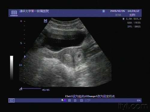 双子宫,纵隔子宫,以及双角子宫 的图片 - 超声医学版