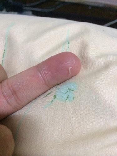 肛门出现白色小虫