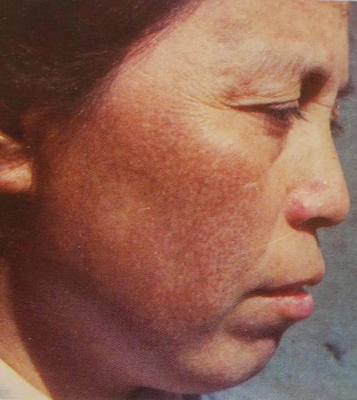 生产油墨工人发生的皮肤黑变病,面颊部呈网眼状