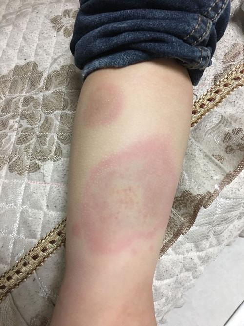 孩子在草地上玩被虫子咬了起了一片红斑而且好痒血常规检查白细胞高