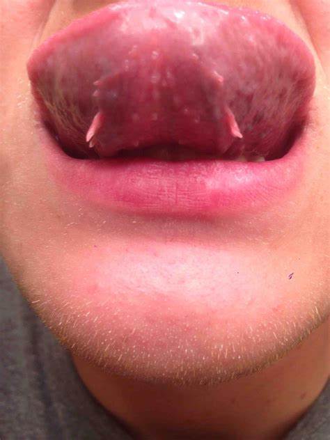 舌下长刺刺到底是不是尖锐湿疣【图片内容可能使您不适,请谨慎点击】