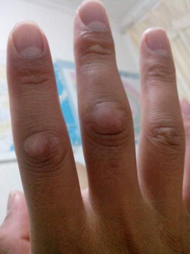 答: 你好,你说的情况考虑是手指关节处皮肤角化引起的症状的,建议你