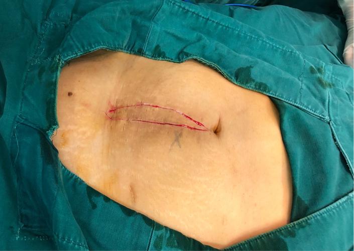 下腹壁切口疝无张力修补