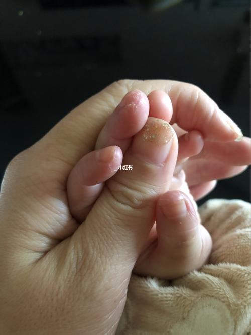 宝宝手指头脱皮 跪求治疗好了的_母婴_育儿经验