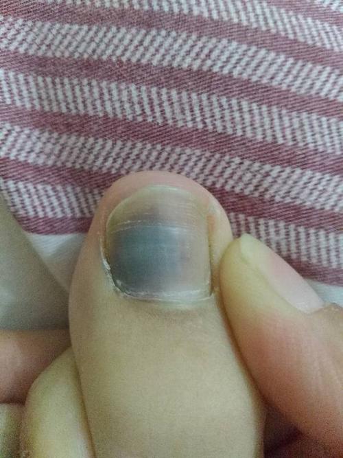 我的脚指甲大拇指前个星期很痛 出现了像瘀血一样的痕迹 是灰指甲还是