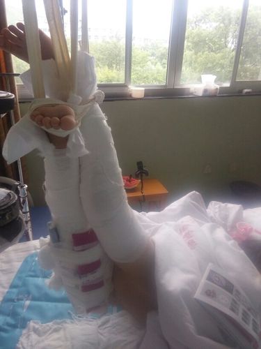 小孩骨头摔断了做了牵引可宝宝都喜欢侧着睡觉会不会影响她的恢复