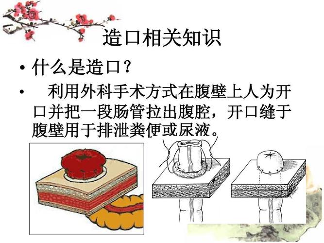 结肠造口的护理查房 主管护师ppt