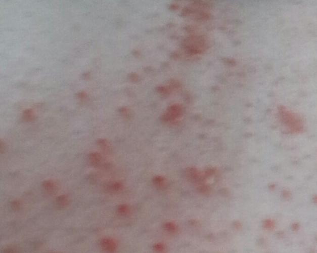 长这种红点点,特别是天气特别热或穿文胸比较紧的话,请问是怎么回事呢