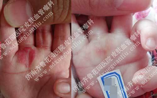婴儿手上血管瘤治疗几次能好