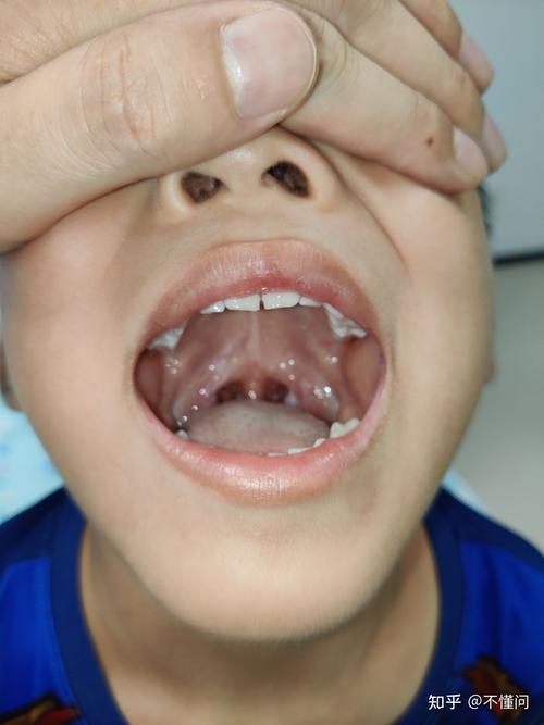 宝宝腺样体肥大与扁桃体肥大手术日记