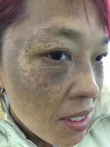 真皮斑形成的真正原因