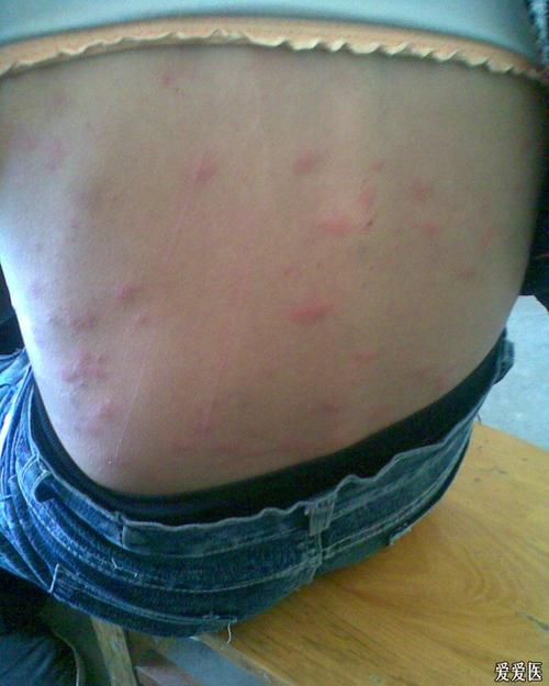 考虑是过敏性皮炎或丘疹性荨麻疹 过敏性皮炎  红色斑丘疹  荨麻疹
