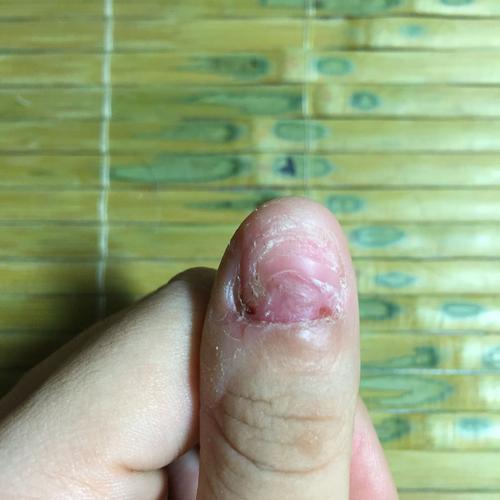 我从小就爱抠指甲 半个月前之前里面出血了我就越扣越大 后来就成了