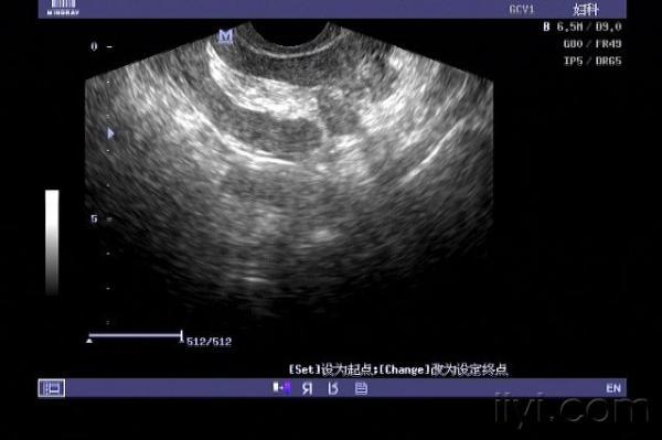 超声诊断子宫穿孔并大网膜嵌顿1例