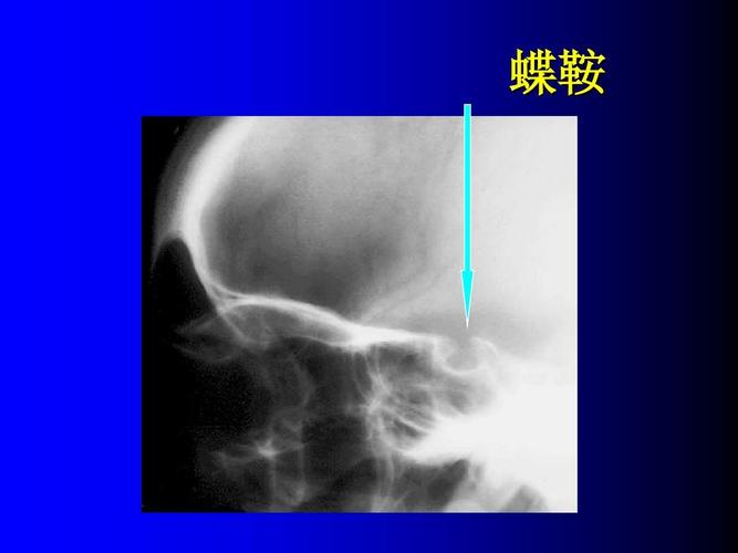 蝶鞍