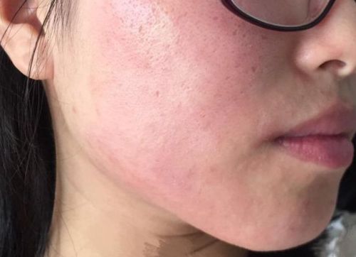 儿童使用化妆品引起过敏病例有所增加