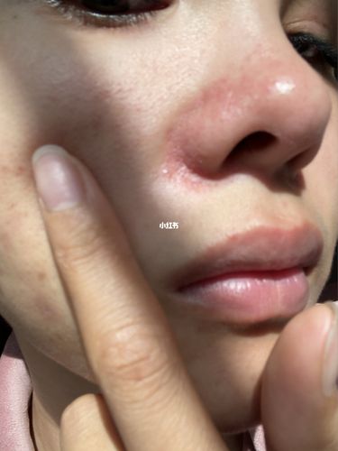 鼻翼脂溢性皮炎刺痛痒.