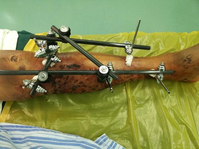 一例胫腓骨近段粉碎性骨折 外固定 术前 术后 [病例帖]