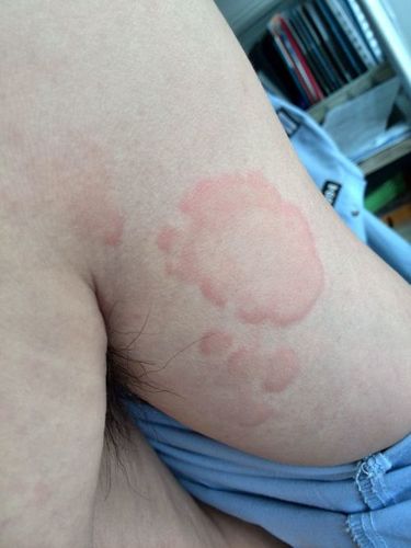 我的病到底是荨麻疹还是离心性环状红斑?属于哪科?怎么治?(见图)