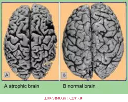 拍片子发现脑萎缩,严重吗?是不是快要痴呆了?