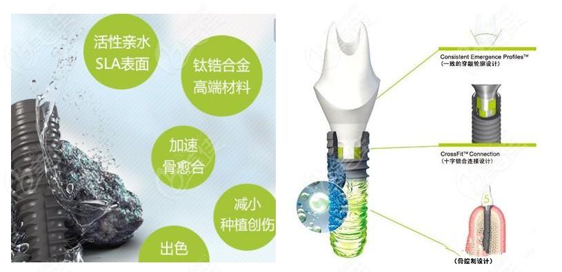 速到杭州江干区美奥口腔与瑞士士卓曼iti亲水种植牙约惠啦