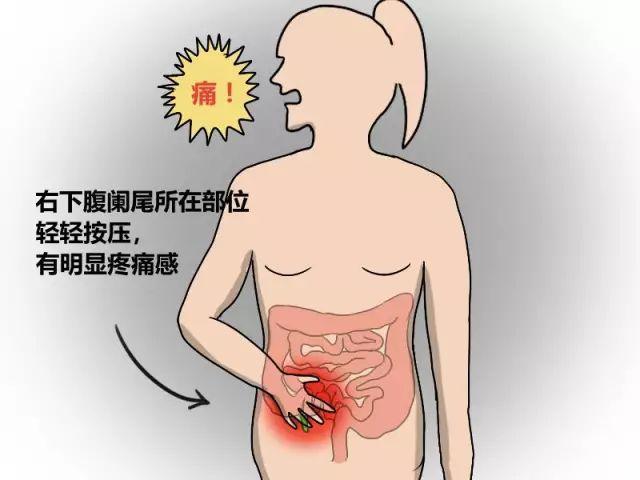 妊娠合并急性阑尾炎,你了解多少?