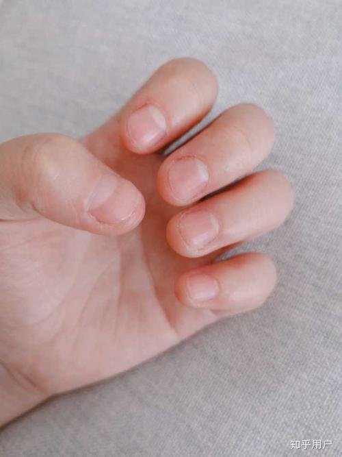 甲床短怎么变长?