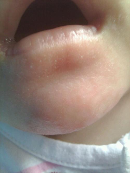 宝宝脸上有奶癣怎么办?