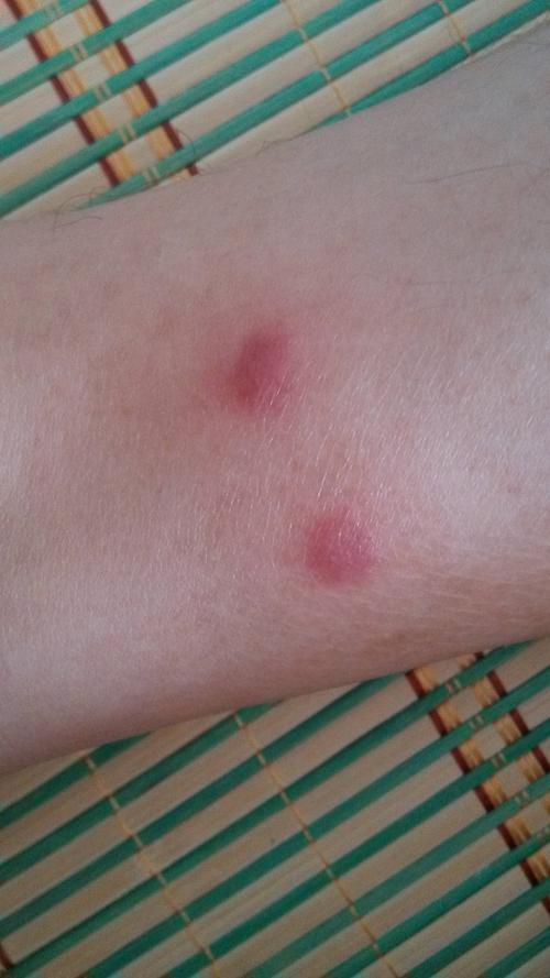 请教一下腿上长的这些红疹到底是啥,去医院看,各种说法,过敏,湿气