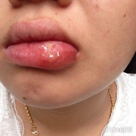 【图】唇疱疹的治疗方法有哪些 不同种类疱疹治疗方法