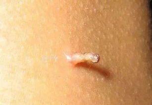 皮肤突然长出小肉疙瘩是怎么回事若是这3种类型请重视