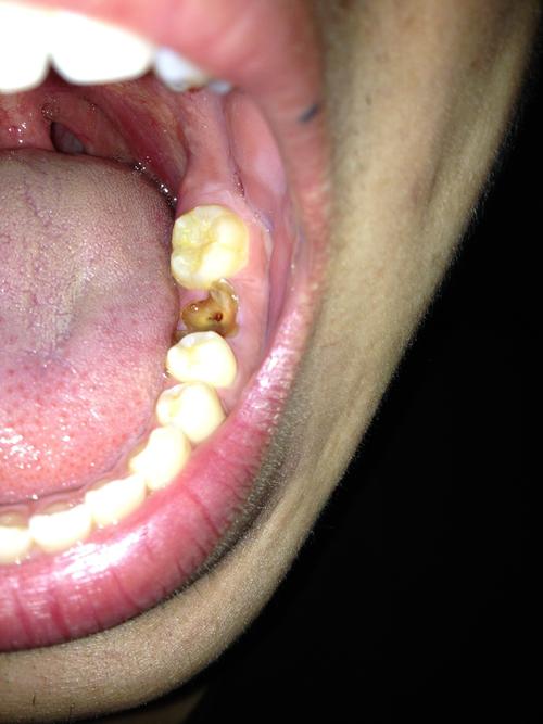 现在牙根发黄发黑,有一个明显的小洞.