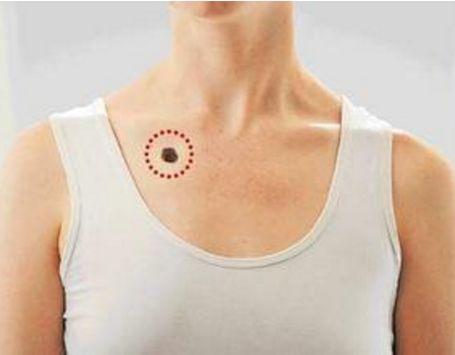 "胸有大痣",别得意,这些痣可能会导致皮肤癌!