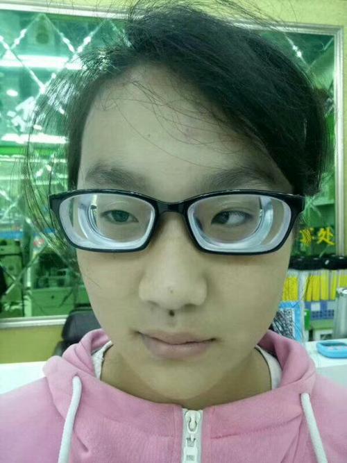 高度近视近视引起的斜视