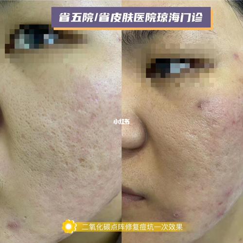 co2点阵激光修复痘坑及毛孔粗大_痘坑_毛孔粗大_皮肤病_海南_点阵激光
