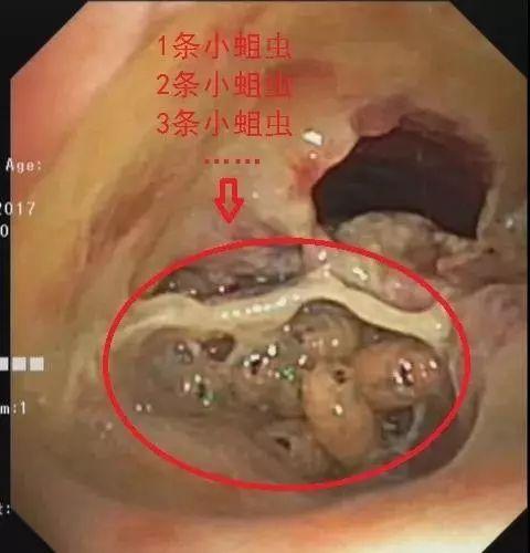深圳一患者气管里竟"养"了一窝蛆虫!密集恐惧症者慎入
